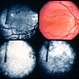 Foveal Hypoplasia